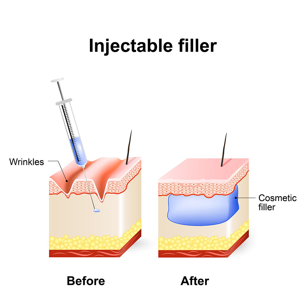 Injectables Topper Cosmetic Injectables - Dr. Harinder S. Chahal MD