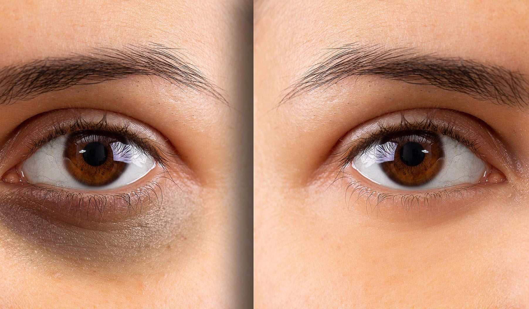 How To Remove Dark Circles In 7 Days