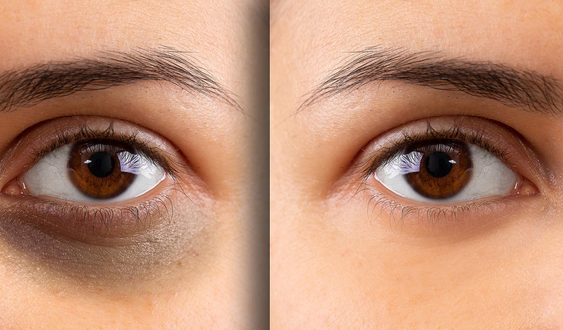Dark Circles Dr Harinder S Chahal MD